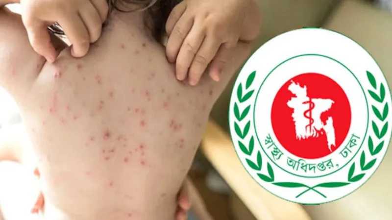 চট্টগ্রামে ৯টি এলাকা হামের ‘হটস্পট’ হিসেবে চিহ্নিতঃ লক্ষণ নিয়ে ৩৫ শিশুর মৃত্যু